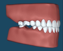 歯の喪失