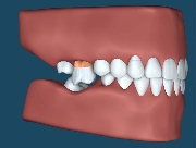 歯のイメージ図
