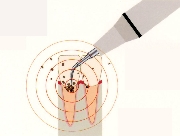超音波による治療イメージ